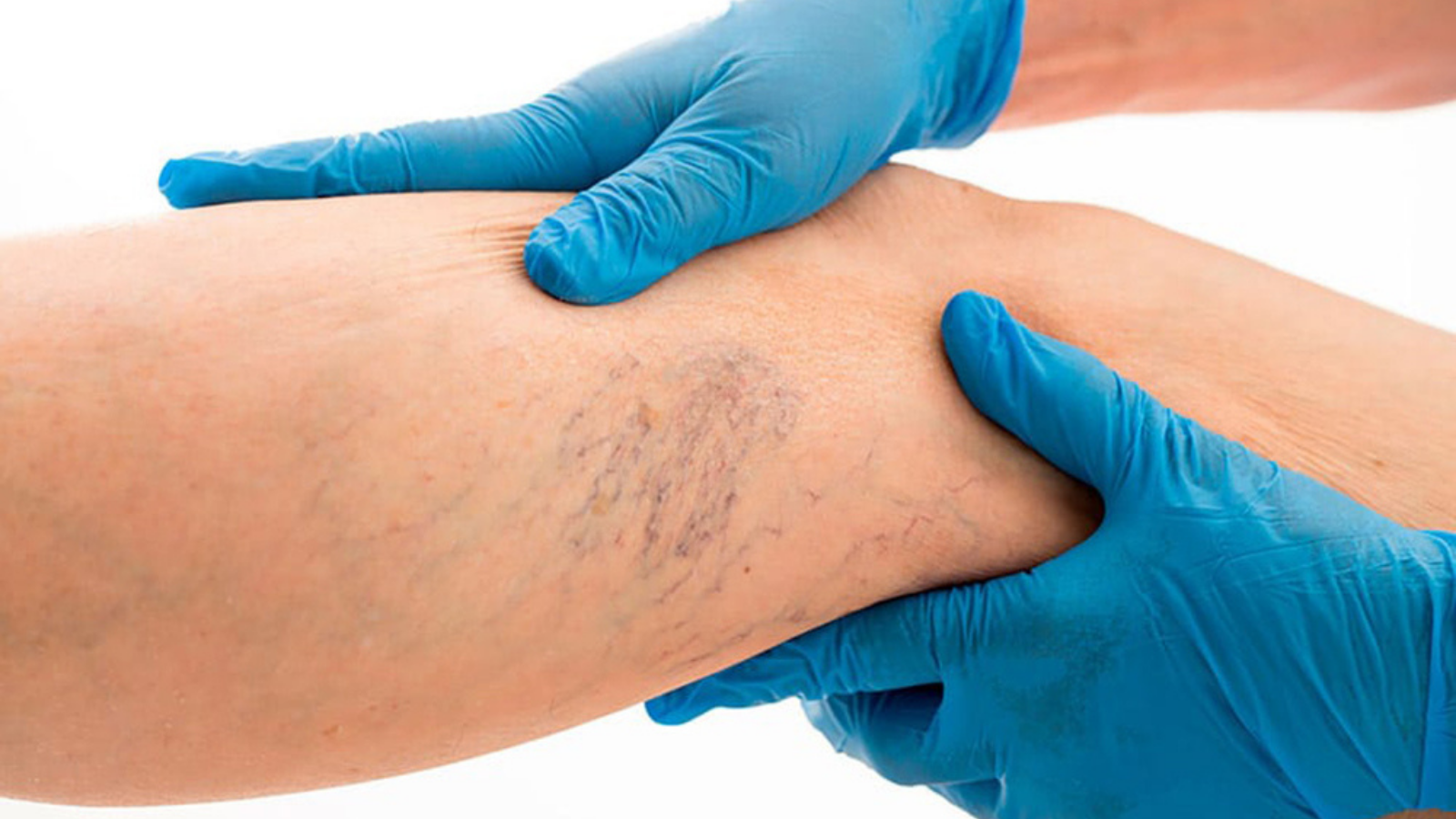 Enfermedad venosa crónica, conoce la clasificación CEAP