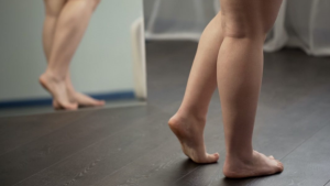 Bultos después de la operación de varices