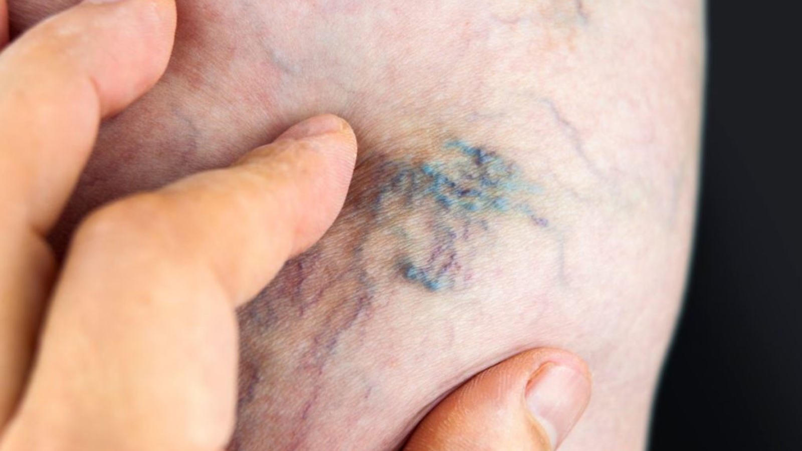 Piernas varicosas y síndrome postflebítico, cómo tratarlo