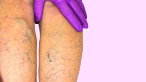 ¿Qué valorar ante un paciente con una úlcera vascular en la pierna?