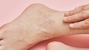 Principales causas de la aparición de varices en los pies