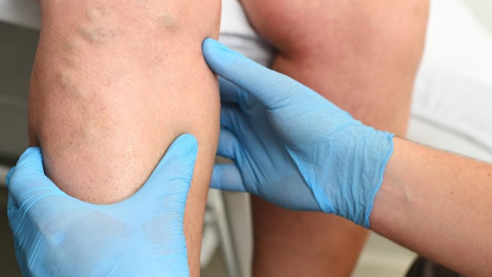 Tratamiento para varices tronculares, ¿se pueden eliminar?