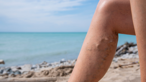 Varices en las piernas en verano: cómo cuidarlas y refrescarlas