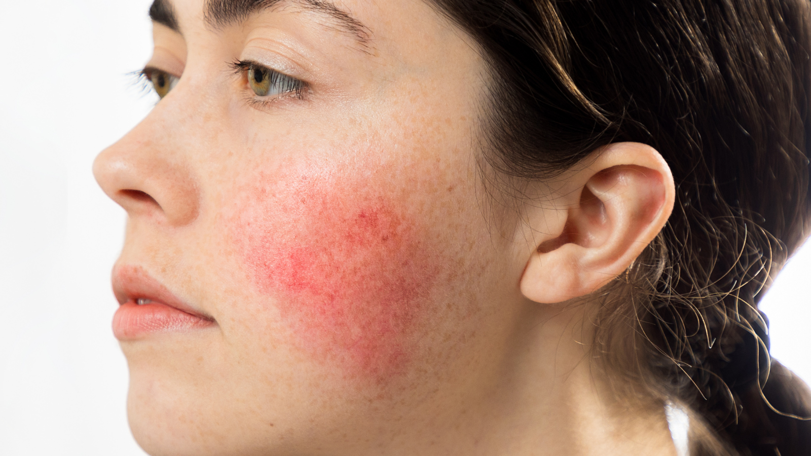 ¿Qué es la cuperosis facial? Aprende a controlarla