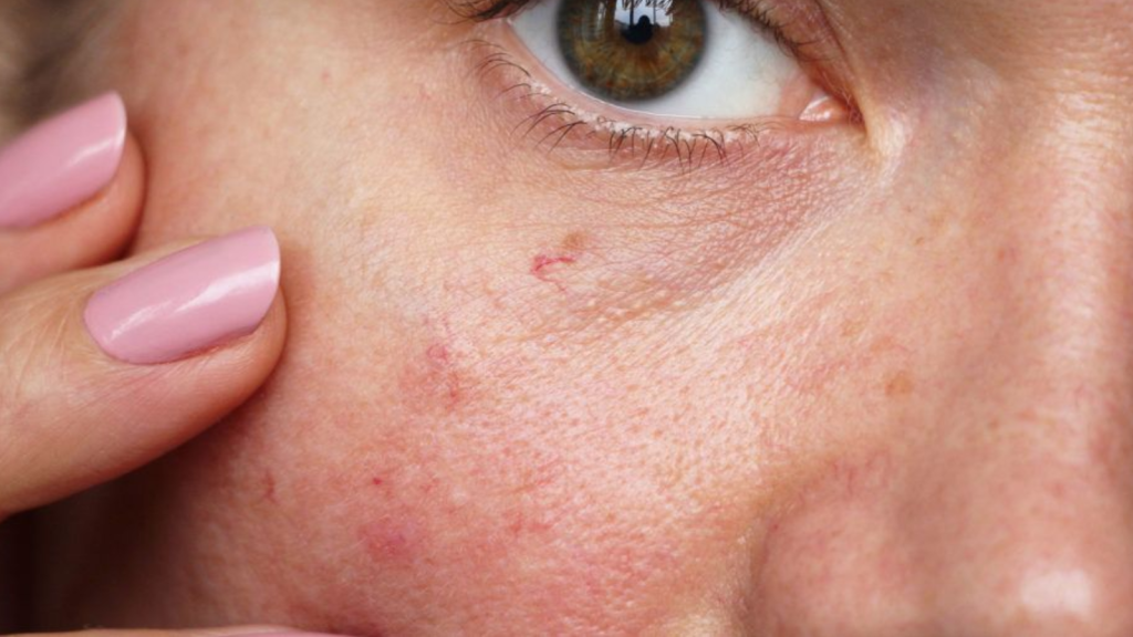 Conoce los factores que producen las telangiectasias y cómo evitarlos