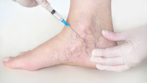 Quiénes son los candidatos ideales para los tratamientos de varices