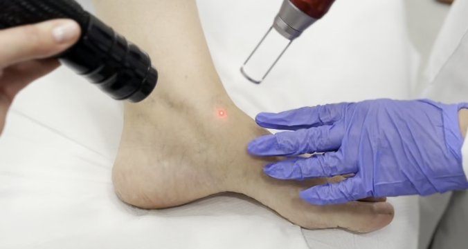 laser vascular_vasculine
