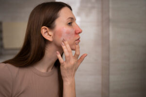 Cómo identificar y diferenciar la cuperosis de otras afecciones de la piel
