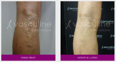 venaseal-antes-y-despues-de-14-meses Venaseal antes y después de 14 meses
