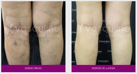venaseal-antes-y-despues-de-10-meses Venaseal antes y después de 10 meses
